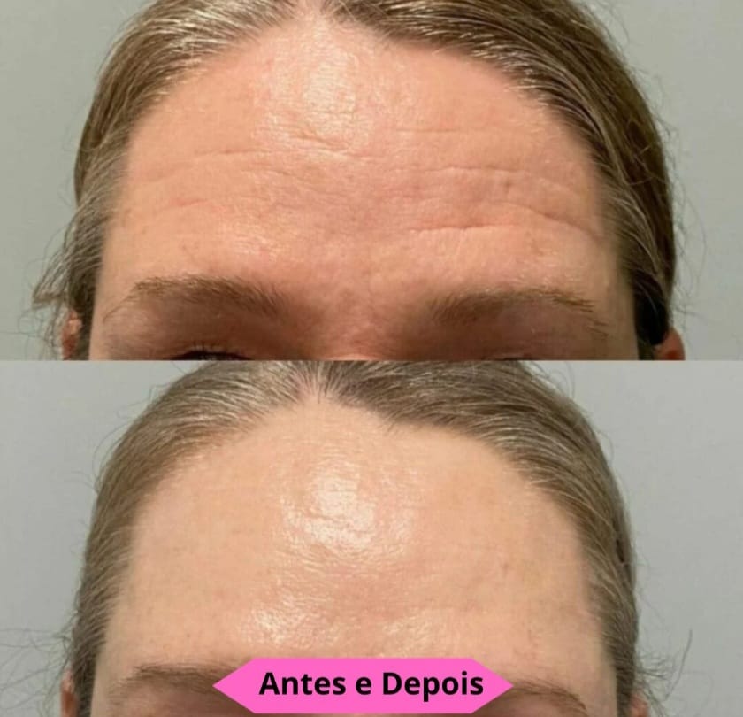 Suplemento para Saúde de Cabelo, Pele, Unha, Ossos e Articulações