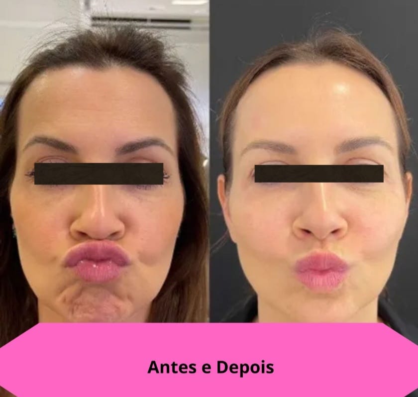 Suplemento para Saúde de Cabelo, Pele, Unha, Ossos e Articulações
